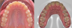 Impronta ottica: la tecnologia 3D  per un’impronta dentale digitale